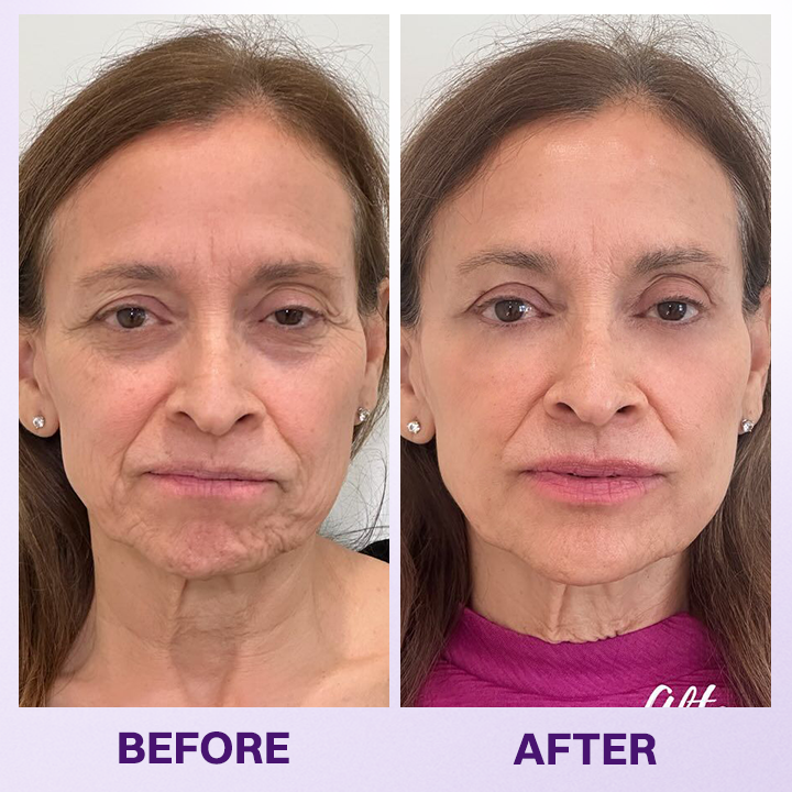 LOVILDS® Instant Lift Eye Gel