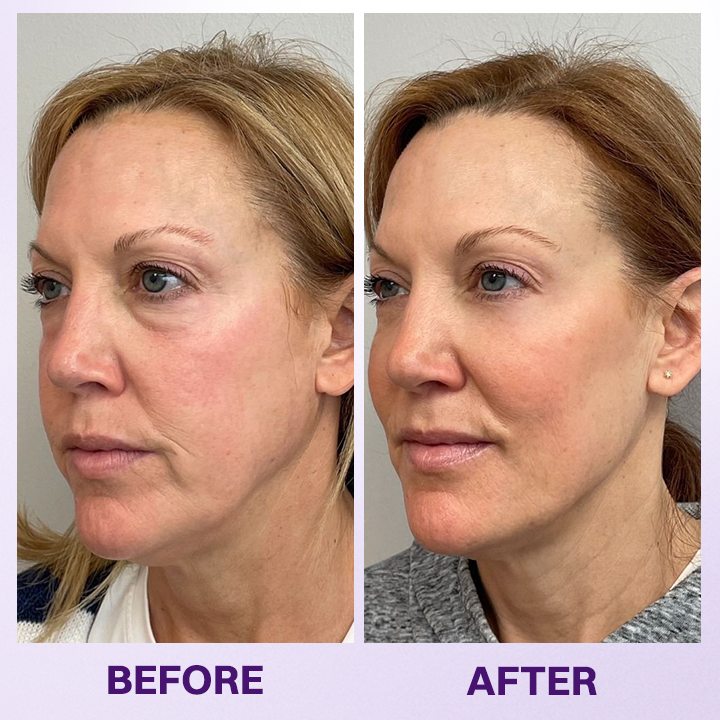 LOVILDS® Instant Lift Eye Gel